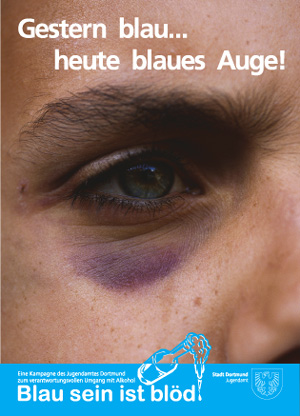ein blaues Auge haben
